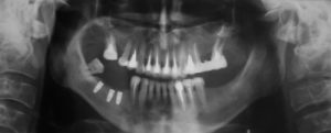 dental-xray-of-missing-teeth
